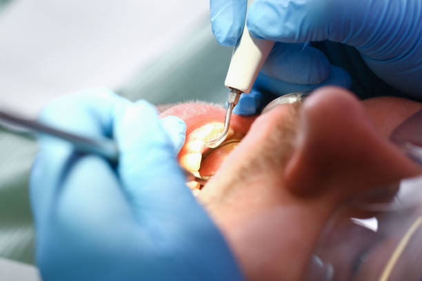 Best Knocked-Out Tooth (Avulsed Tooth) Treatment in Kihei, HI